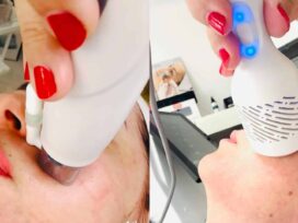 Mikrotűs rádiófrekvenciás kezelés Apollon Beauty kozmetikában