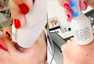 Mikrotűs rádiófrekvenciás kezelés Apollon Beauty kozmetikában