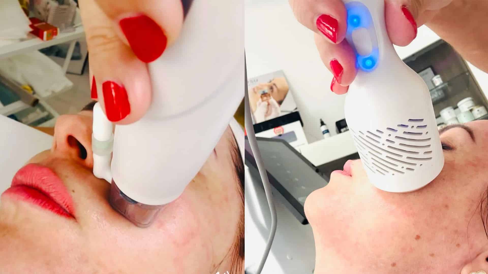 Mikrotűs rádiófrekvenciás kezelés Apollon Beauty kozmetikában